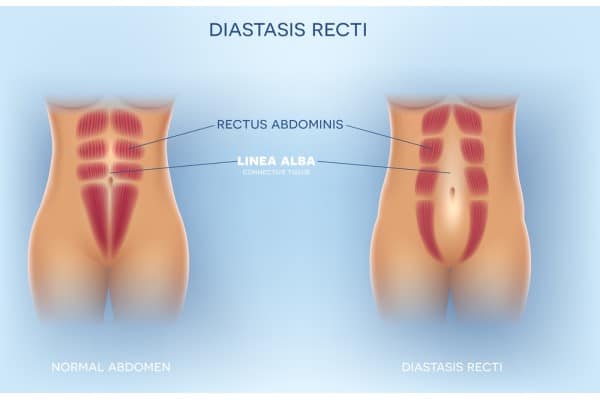 What Non-Surgical Options Are Available for Diastasis Recti Murrayfield?