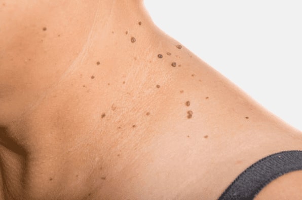 Are you looking for easy skin tag removal Murrayfield - then contact Spire today!