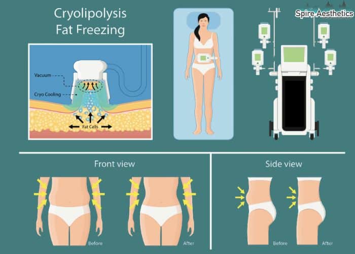 Image of diet and fat freezing combined for best results for Spire Aesthetics Murrayfield