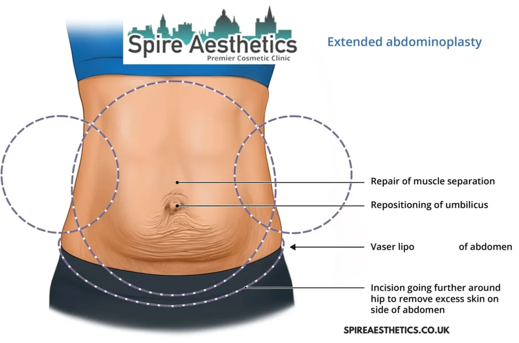 Understanding Loose Skin After Gastric Band Murrayfield Surgery and HIFU Treatment