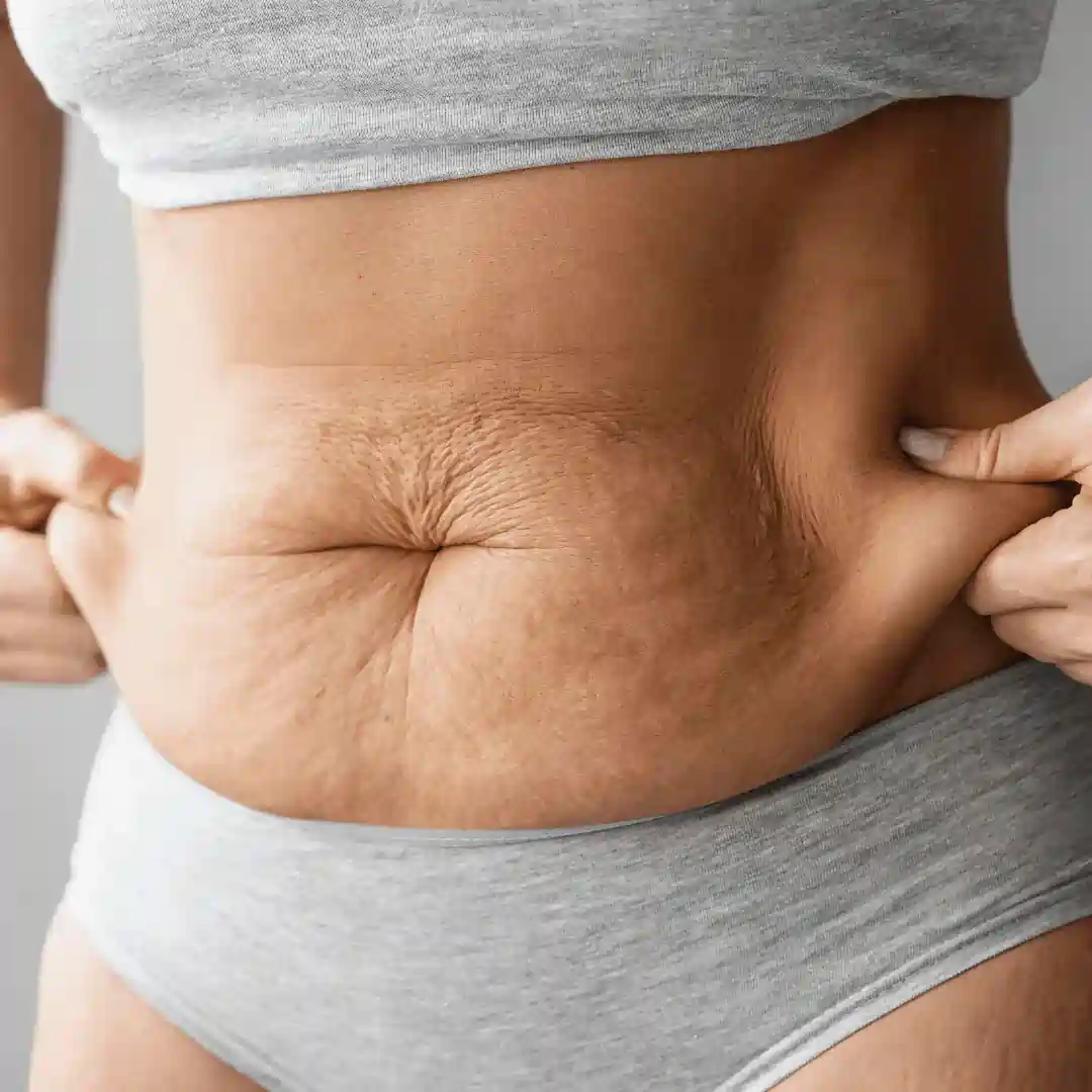 Is It Normal to Have Loose Skin After Pregnancy Murrayfield?